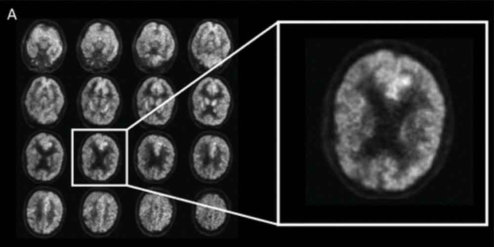 Künstliche Intelligenz diagnostiziert frühzeitig Alzheimer