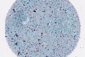 Microsoft: Neue KI soll Gebärmutterhalskrebs früh erkennen