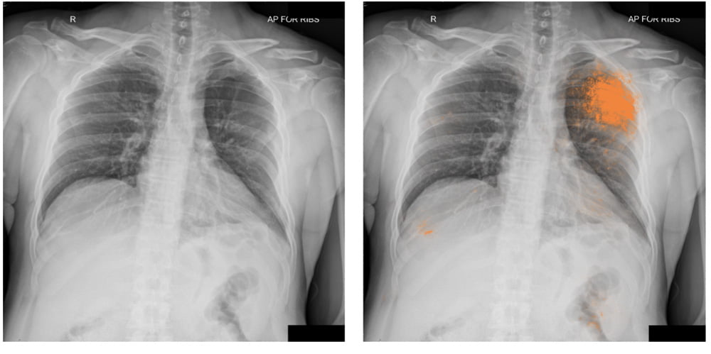 Links die Original Röntgenaufnahme, rechts sind die von der KI als auffällig diagnostizierten Gewebeabschnitte orange markiert. Bild: Google.