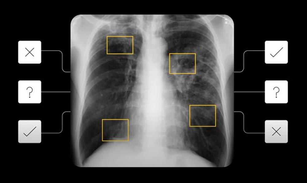 Auf Arzt-Niveau: Google bekämpft Tuberkulose mit KI